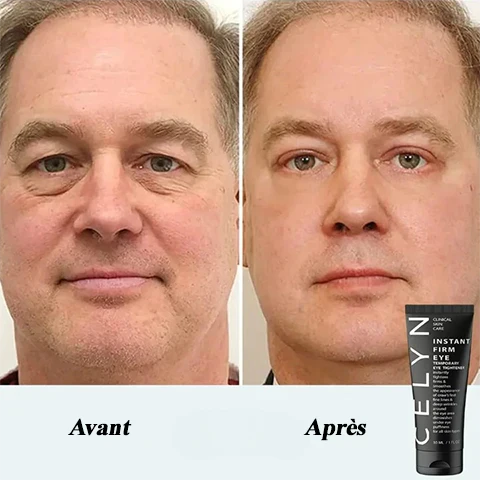Crème Celyn avant après sur les poches sous les yeux